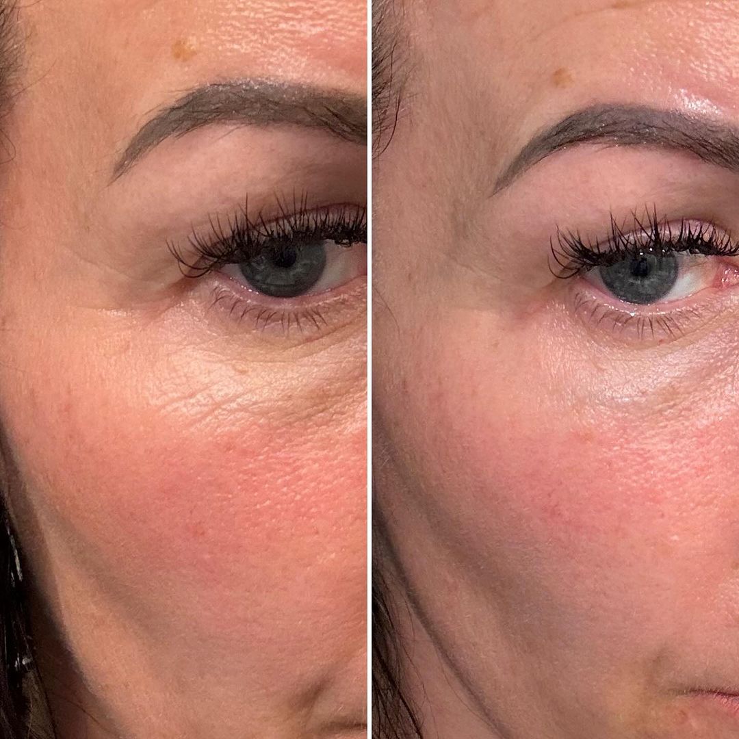 MYSKINBUDDY BOOST Pretty - in - Pink