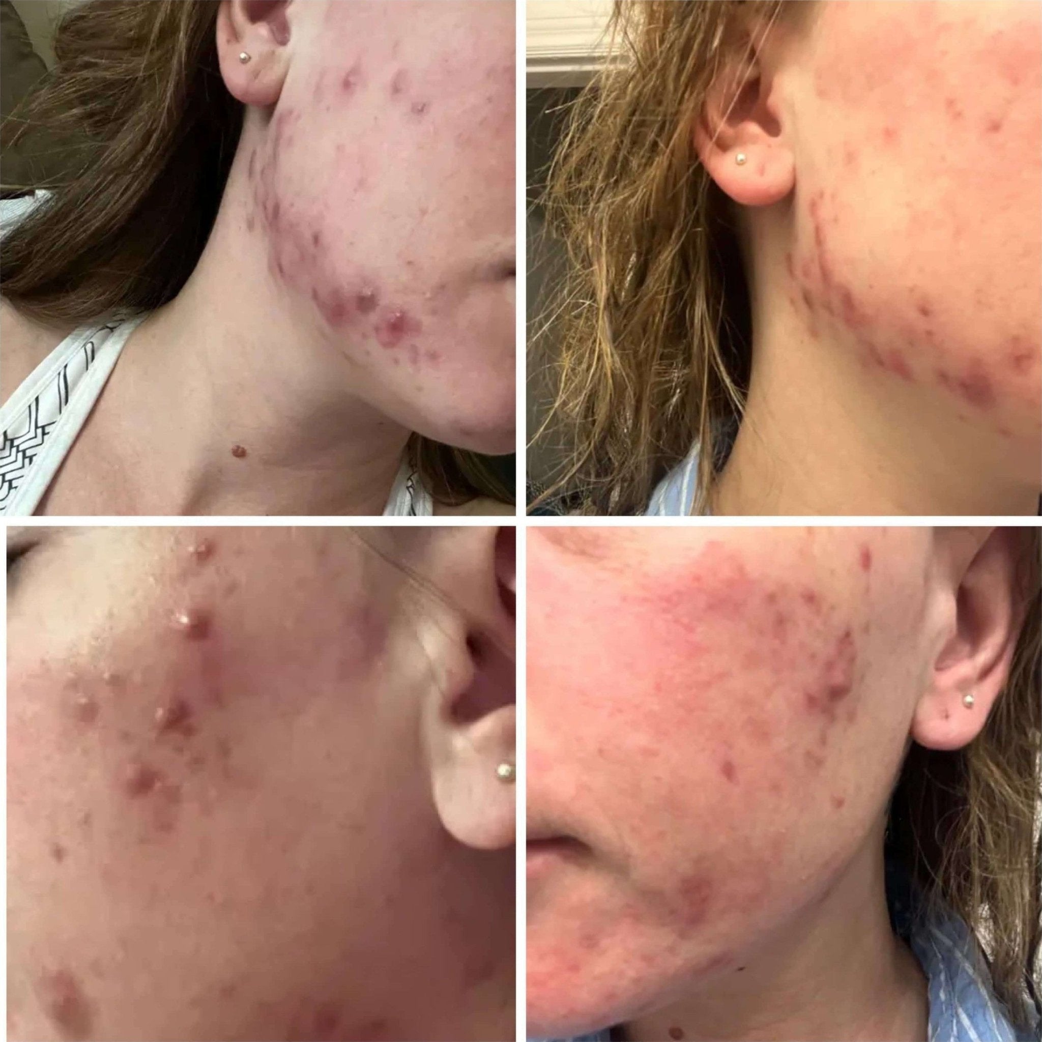 The Spoiled Mama BalanC Toner - Bright Clear Skin | Pregnancy - safe Acne Toner